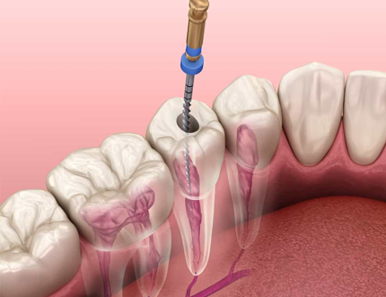 Root Canal Specialist in Indiranagar